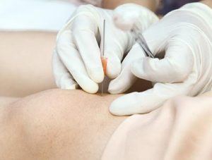 Phương pháp cấy chỉ trong Y học Cổ truyền có hiệu quả tốt